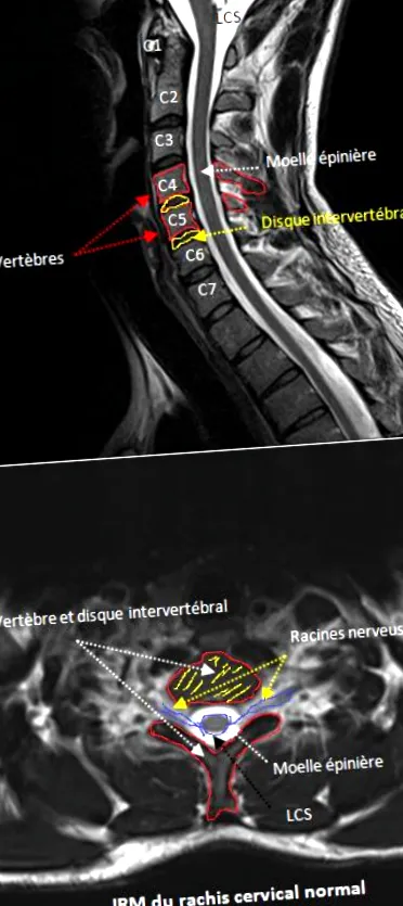 cervical