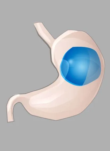 balonul intragastric