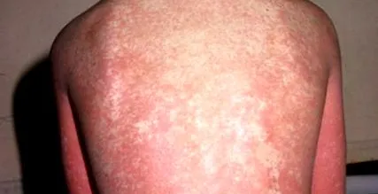 csoport streptococcus