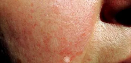 folliculorum