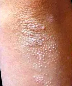 gyógynövényekkel psoriasis