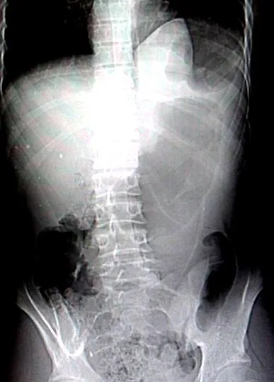 gastric