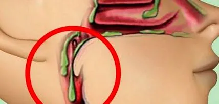 exces