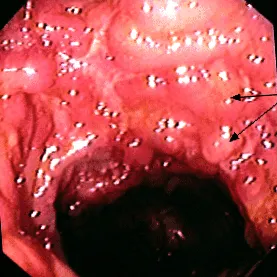 crohn