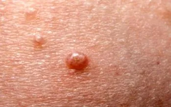 contagiosum