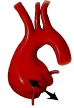 aneurysma