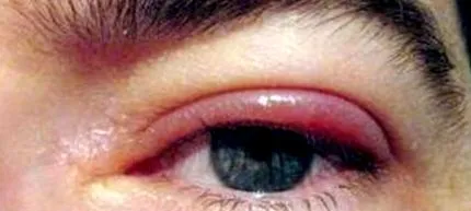 herpes