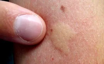 allergiás reakció