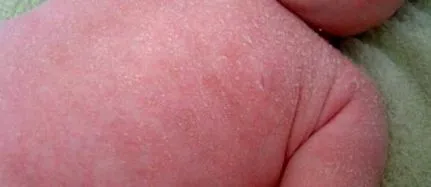 atópiás dermatitis