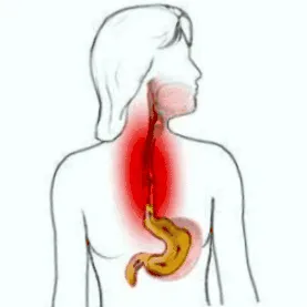 reflux betegségét