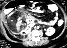 angiomyolipoma