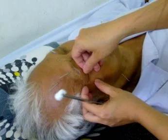 acupunctura