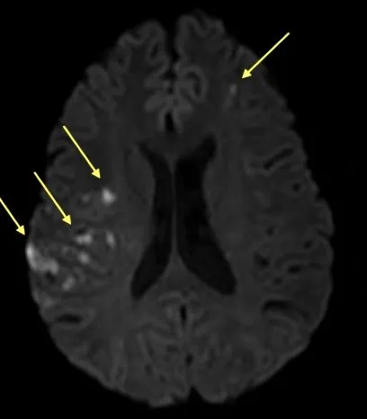 cerebral