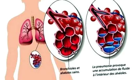 pneumoniei