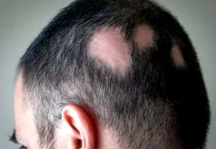 alopeciei