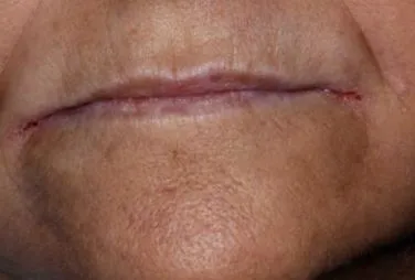 candidiasis