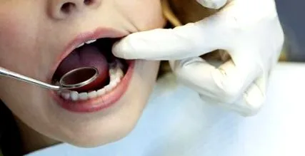 caries