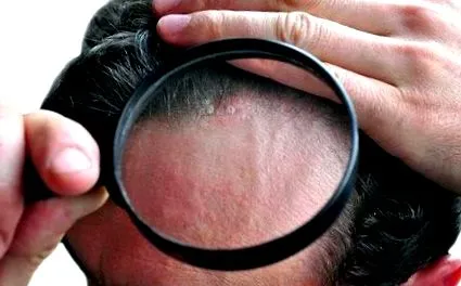 dermatitis