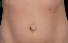 kezelése köldök