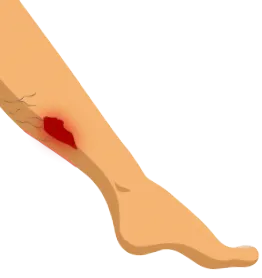 ulcer