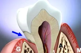 osul alveolar
