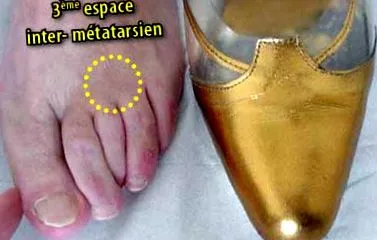 bursa reszekciójával