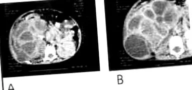 pyelonephritis