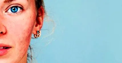 rosacea