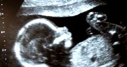 nuchal áttetszőség mérése