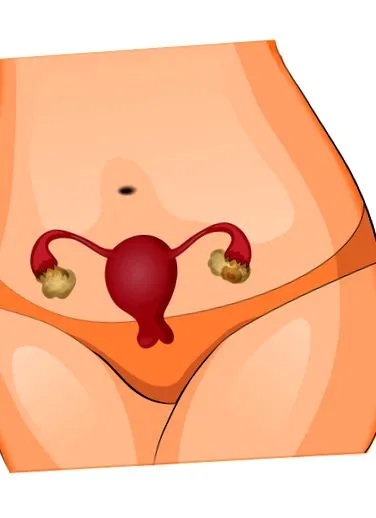 montpellier endometriozei