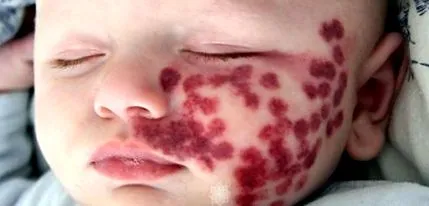 angioma
