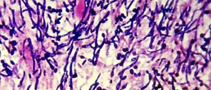mycosis mycosis