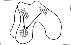 osteoarthritis