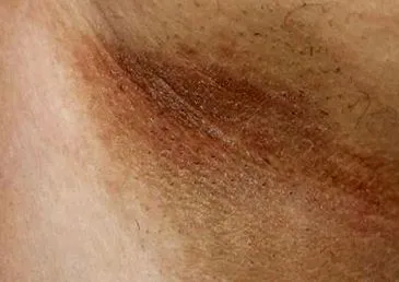 acanthosis nigricans