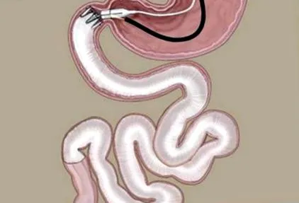 endobarrier