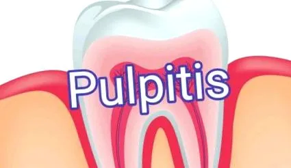 pulpitis