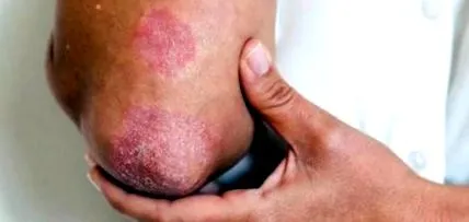 psoriasis