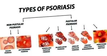 pustuláris