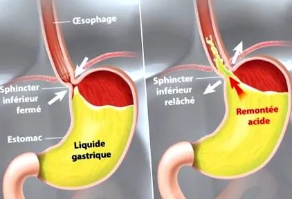 reflux gastroesofagian