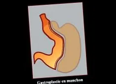 műtét után gyomor varratán