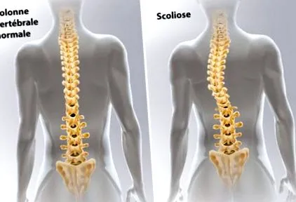 scoliosis