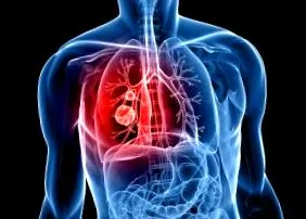 pulmonar