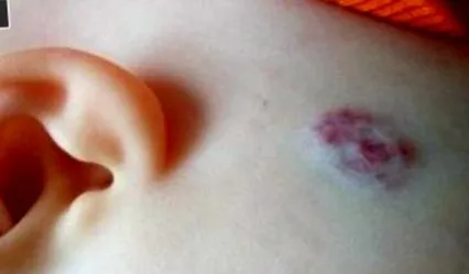 melanoma
