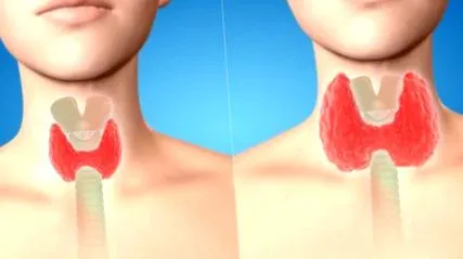 hipotiroidism