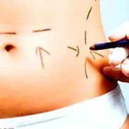 abdominoplastie