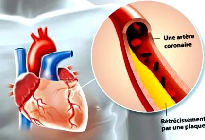angina