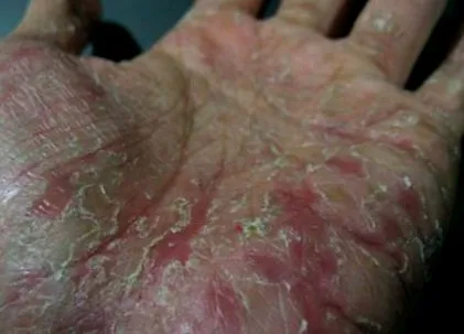 palmoplantare remediilor