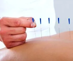 ameliorează acupunctura