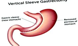laparoscopic