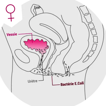 cystitis cystitis